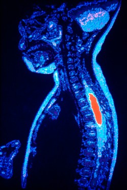 MRI Showing Tumor in Spine